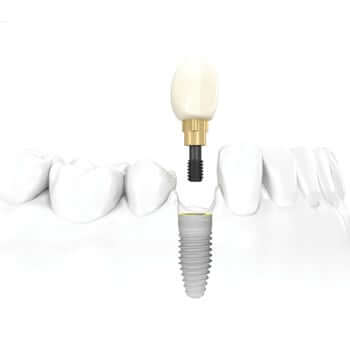 Dental Implants